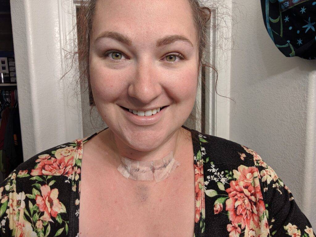 thyroidectomy scar day 2