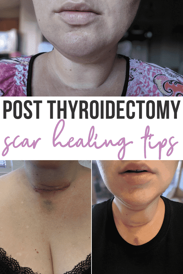 Thyroidectomy Scar Healing Tips