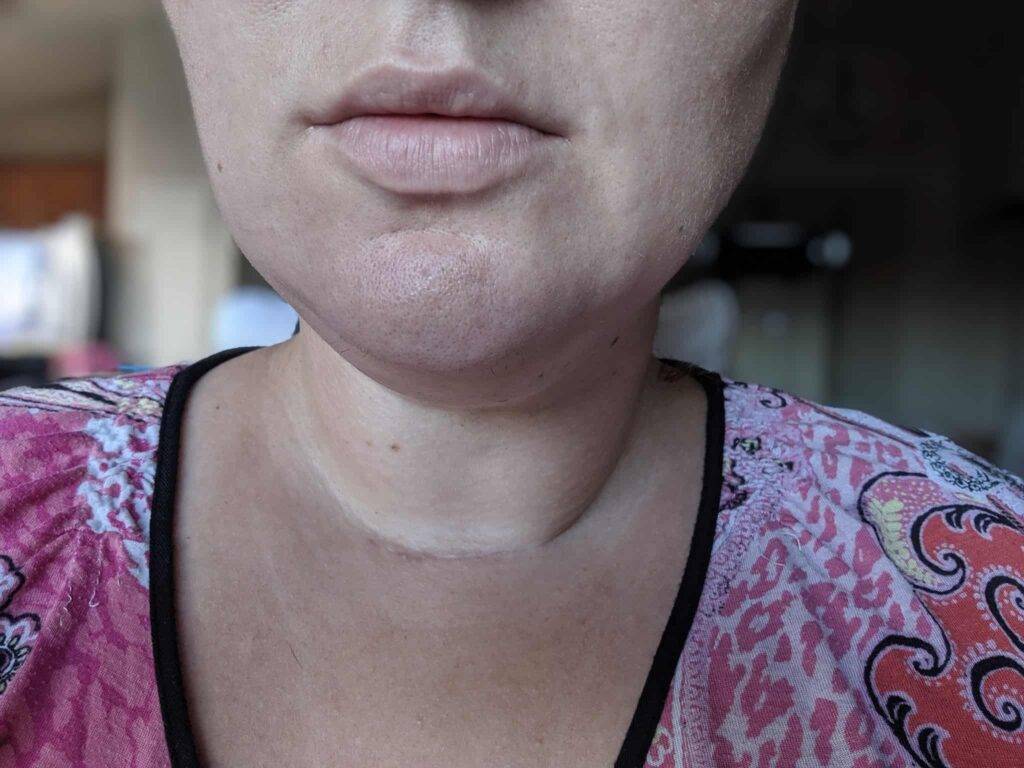 thyroidectomy scars