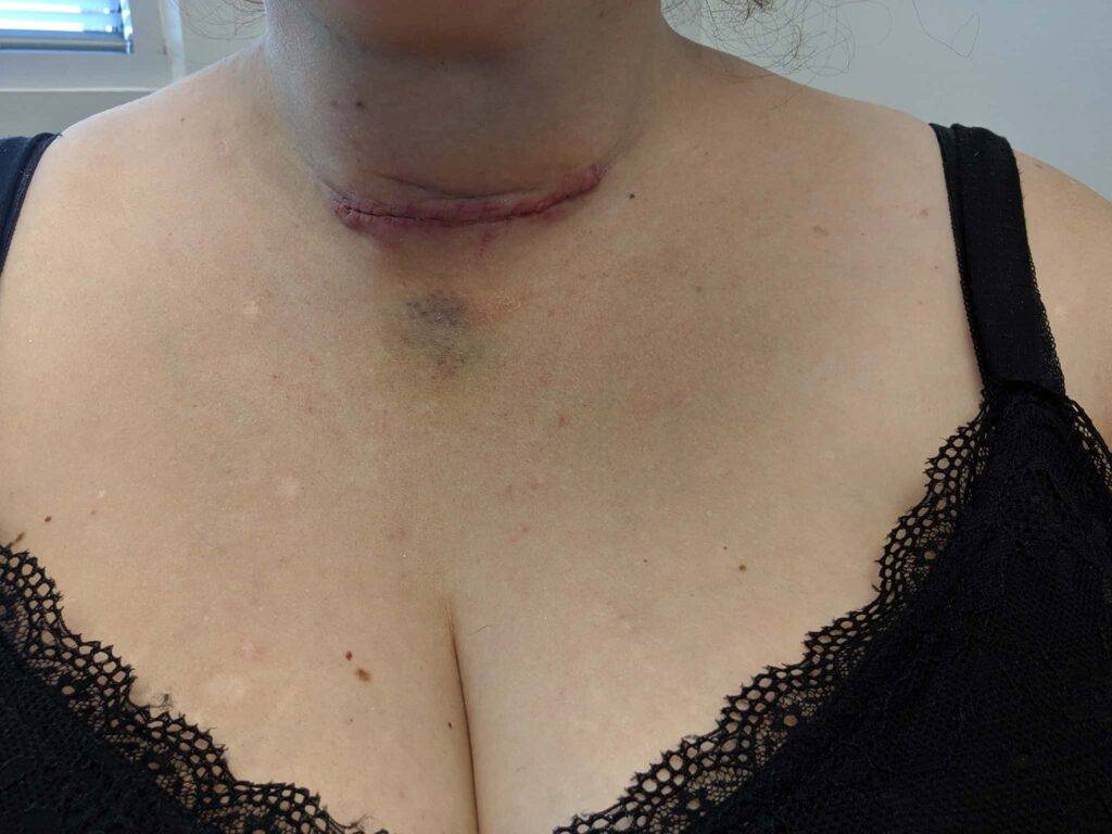 thyroidectomy bruising