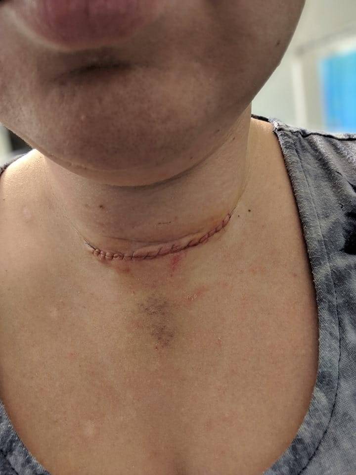 How Long Should Steristrips Stay On After Thyroidectomy?