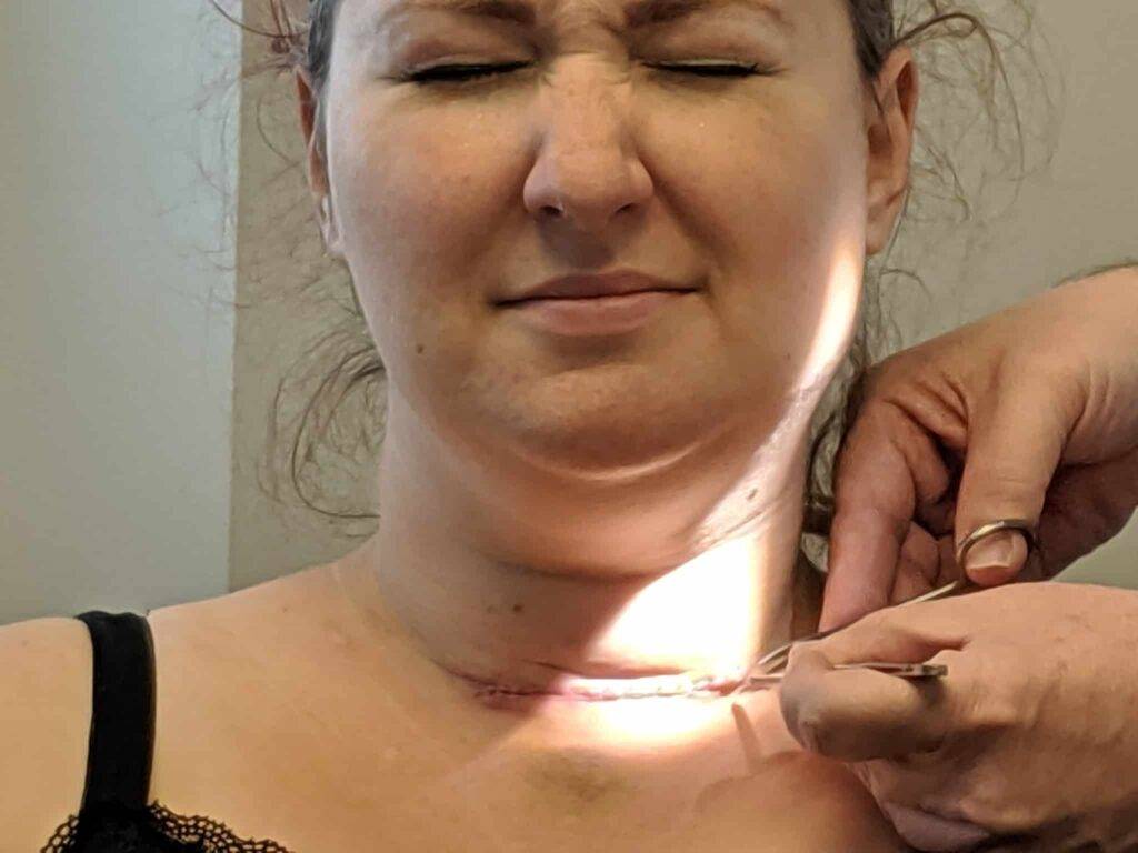 stitch removal thyroidectomy